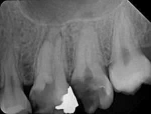 endodoncija-2 (3)